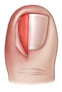 ingrown toe nail cyprus 2.jpg